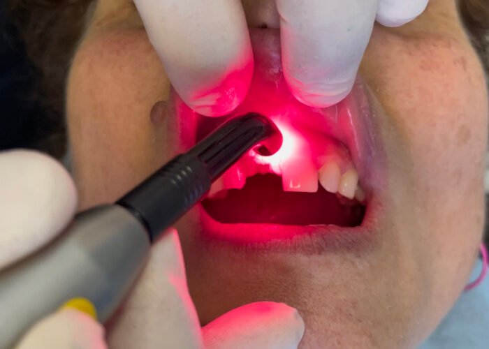 laser terapia